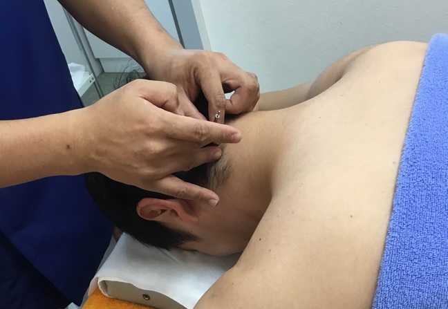 若山台鍼灸整骨院・鍼治療